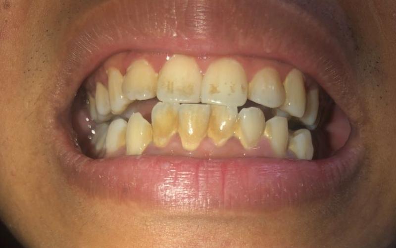 Răng bị ố vàng gây mất tự tin khi cười và giao tiếp