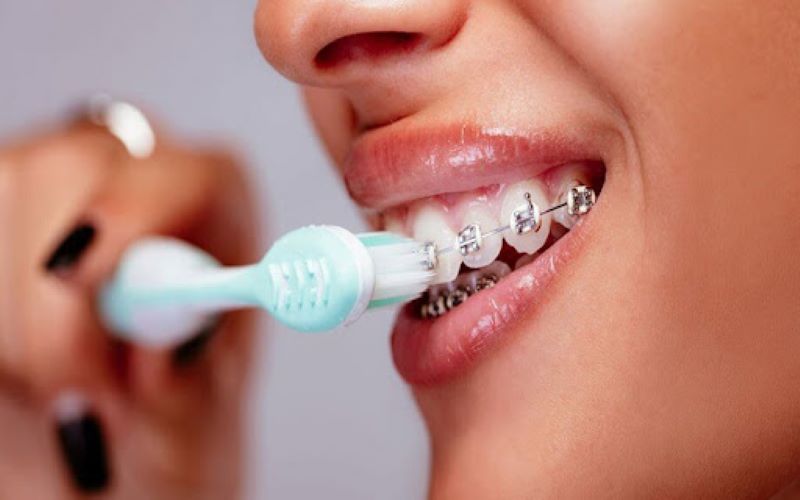 Đánh răng không đúng cách có thể gây tụt lợi