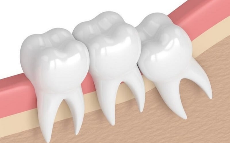 Giá nhổ răng khôn mọc lệch tùy theo tình trạng răng