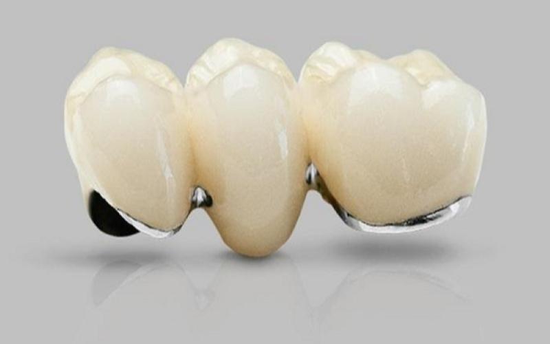 Răng sứ Crom Coban có giá từ 2 - 3 triệu đồng