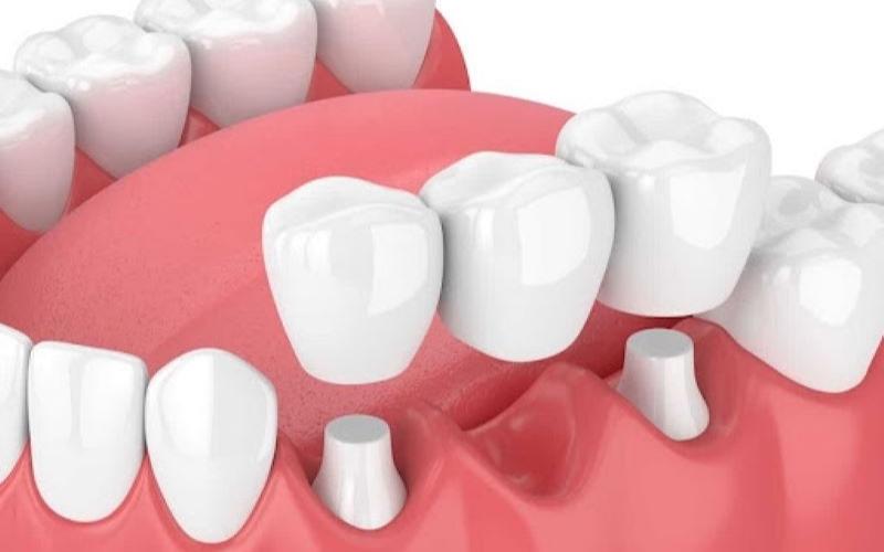 Làm cầu răng sứ vẫn sẽ bị tiêu xương hàm