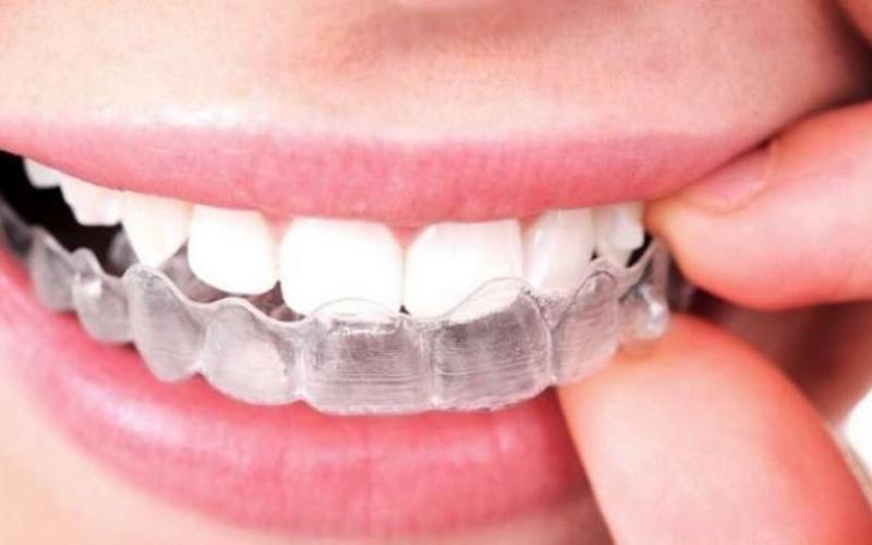 Máng tẩy trắng răng phải đeo ít nhất 2 tiếng/ngày mới đem lại hiệu quả