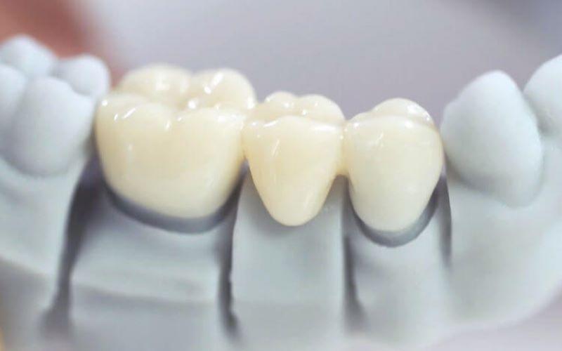 Mão sứ kém chất lượng là nguyên nhân làm răng sứ bị ố vàng