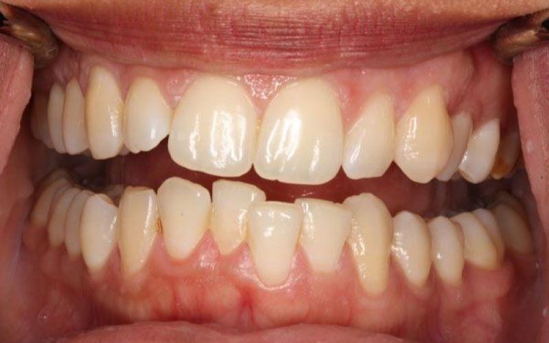 Người có răng bị hô có thể dùng mắc cài mặt trong