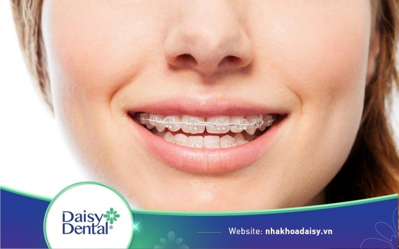 Niềng răng mắc cài pha lê
