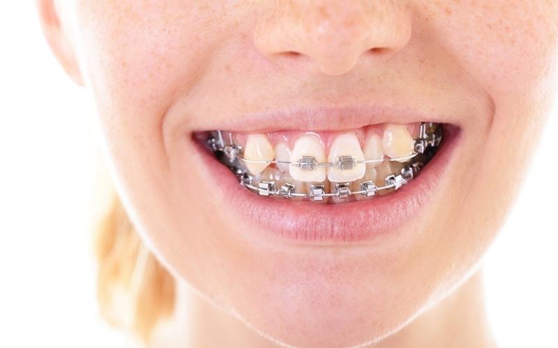 Niềng răng mất thời gian bao lâu?