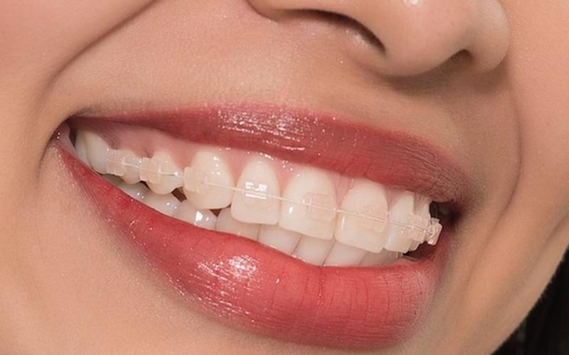 Niềng răng thẩm mỹ là phương pháp chỉnh nha phổ biến hiện nay