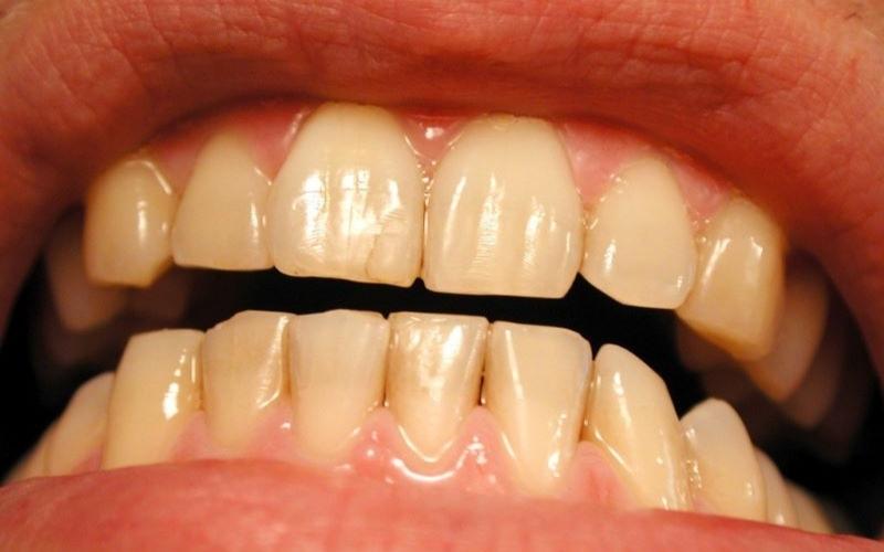 Răng bị ố vàng có thể tẩy trắng
