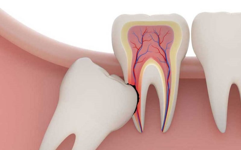 Răng khôn mọc lệch, mọc ngầm hoặc chèn ép các răng khác đều cần phải nhổ