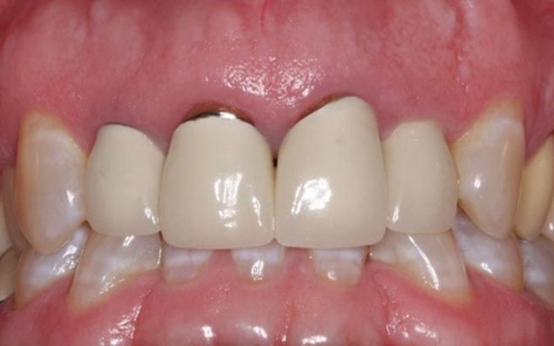 Hở chân răng là biểu hiện răng sứ bị hỏng