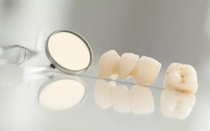 Chất lượng răng sứ là yếu tố quan trọng ảnh hưởng đến vấn đề xỉn màu của răng sứ