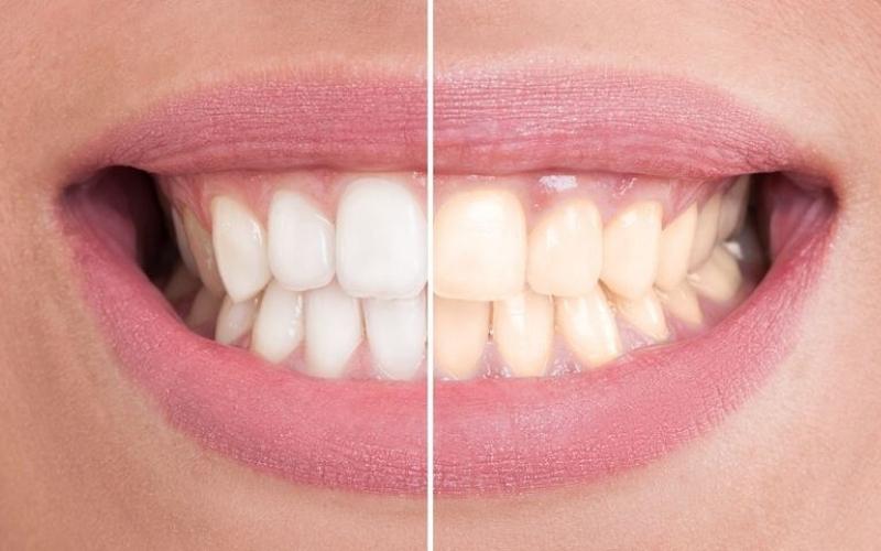 Tẩy trắng răng không gây hại cho sức khỏe răng miệng