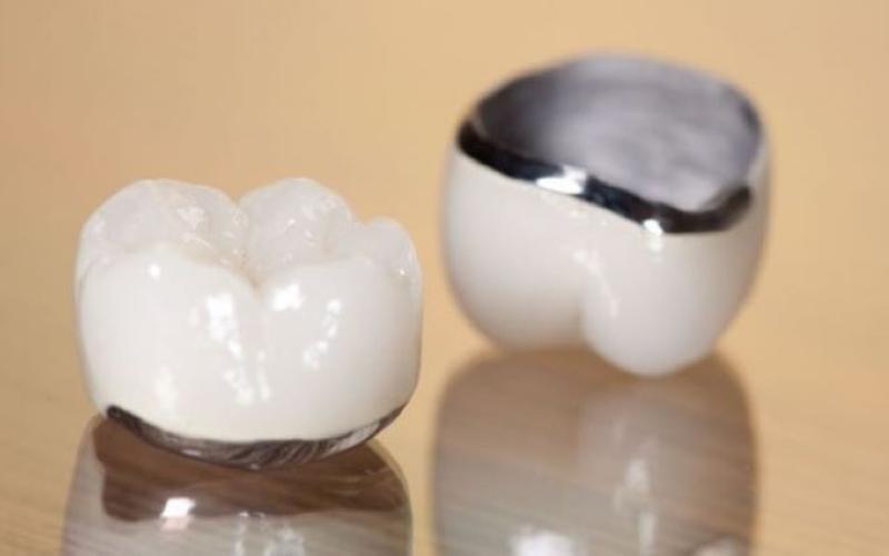Răng sứ Chrome Cobalt ứng dụng tốt nhất khi làm cầu sứ dài