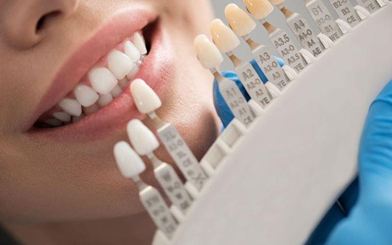 Thay răng sứ mới là cách khắc phục tình trạng răng sứ bị xuống màu