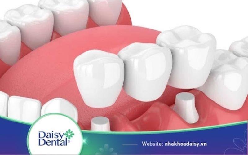 làm cầu răng sứ có bị tiêu xương không