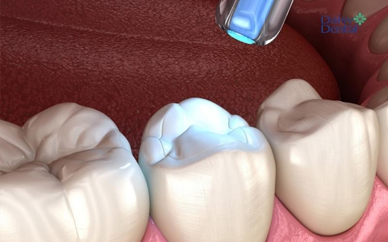 Trám răng điều trị viêm tủy hồi phục