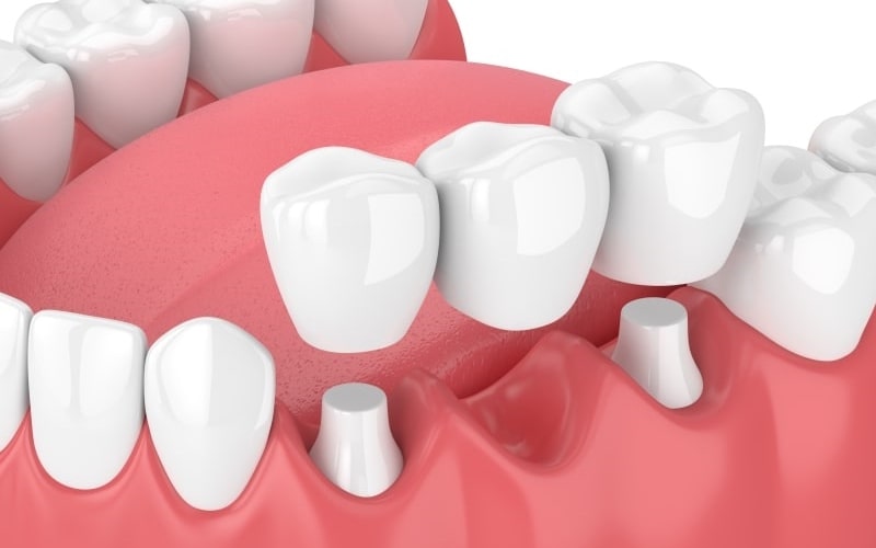 Trồng răng giả là một phương pháp phục hình răng