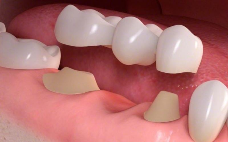 Cầu răng răng sứ là hình thức sử dụng 3,4 hoặc nhiều nhất là 5 mão sứ chụp lên răng