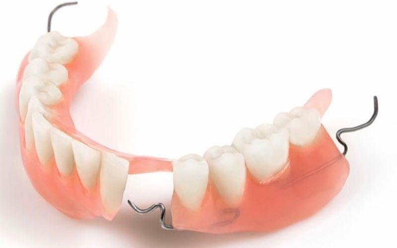 Hàm giả tháo lắp được sử dụng khi mất răng toàn hàm hoặc bán hàm
