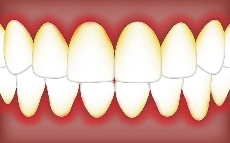 Nha chu là một bệnh lý răng miệng cần phải điều trị kịp thời