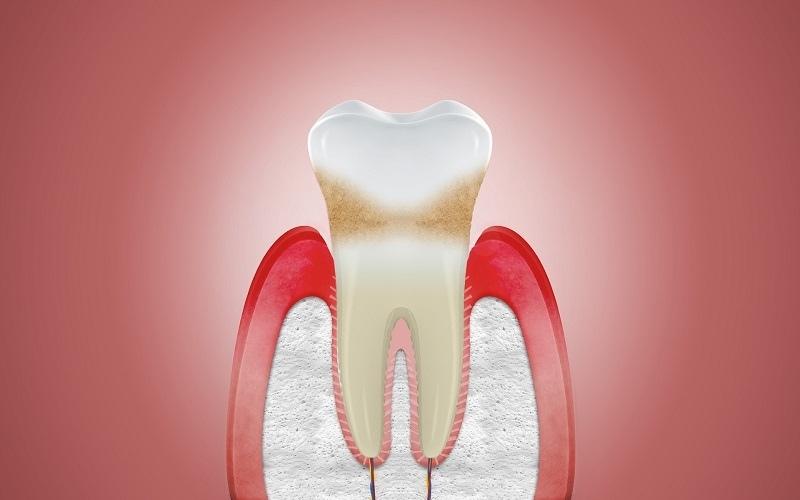 Viêm nha chu là một nguyên nhân gây đau răng cấm