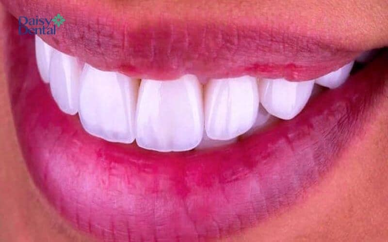 Bọc răng sứ giúp bảo vệ răng khỏi những vi khuẩn gây hại