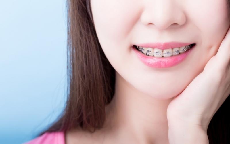 Chi phí niềng răng khớp cắn ngược phụ thuộc vào loại mắc cài mà bạn lựa chọn