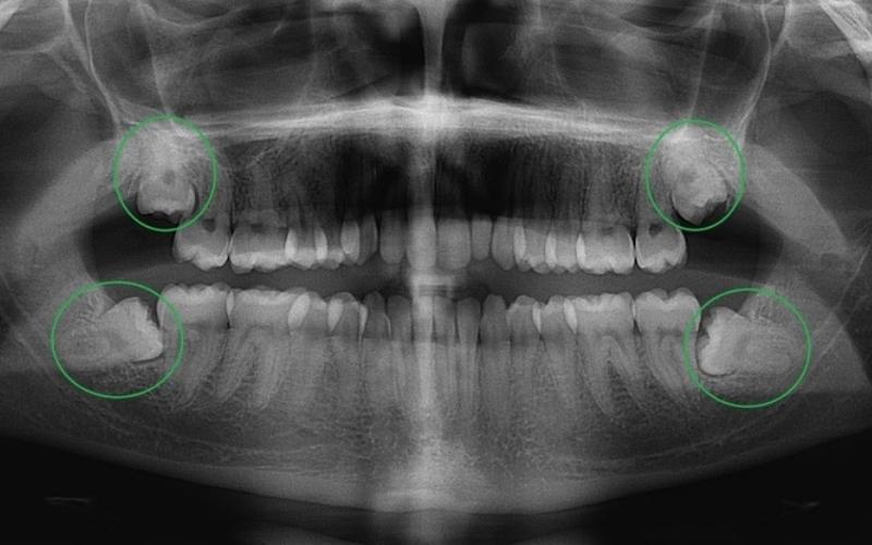 Chụp X quang cho biết chính xác vị trí mọc răng số 8