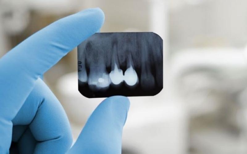 Chụp X quang răng giúp xem chi tiết toàn bộ khung xương hàm và răng