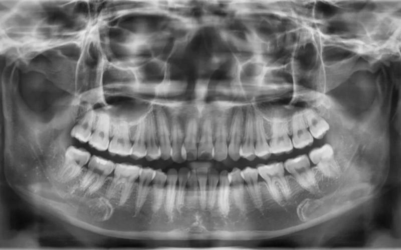 Phương pháp chụp X quang răng toàn cảnh