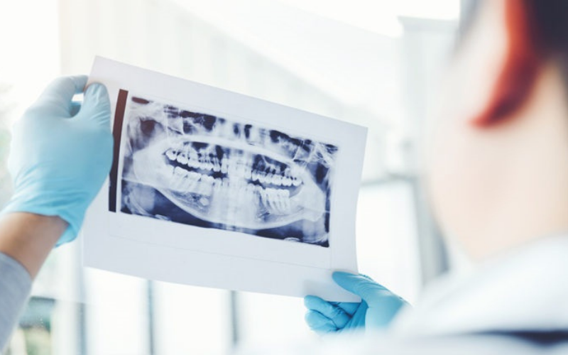 Chụp X quang toàn cảnh răng