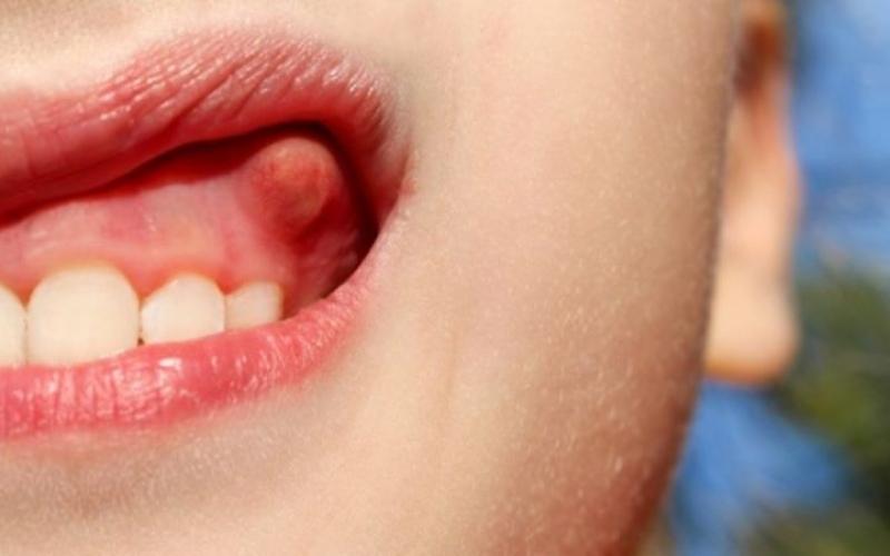 Áp xe răng là bệnh lý phổ biến ở người