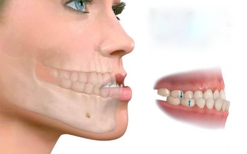 Khớp cắn ngược do răng hàm dưới bị chìa ra trước nhiều hơn so với răng hàm trên