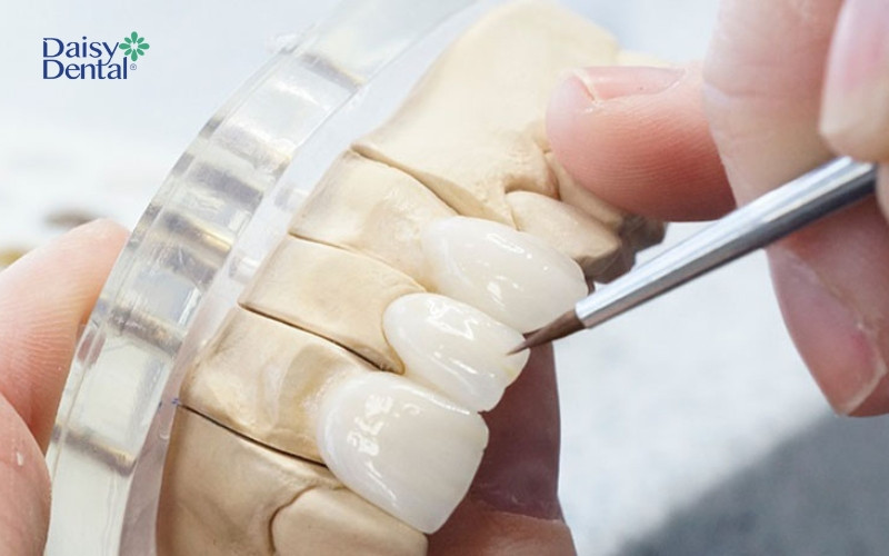 Lấy dấu răng và chế tác răng sứ