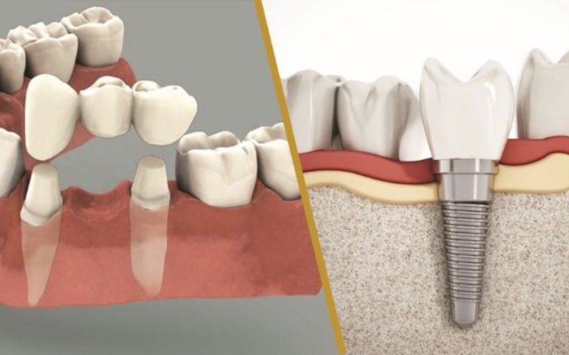 Tùy vào tình trạng răng miệng của bản thân mà bạn có thể lựa chọn cầu răng sứ hay Implant