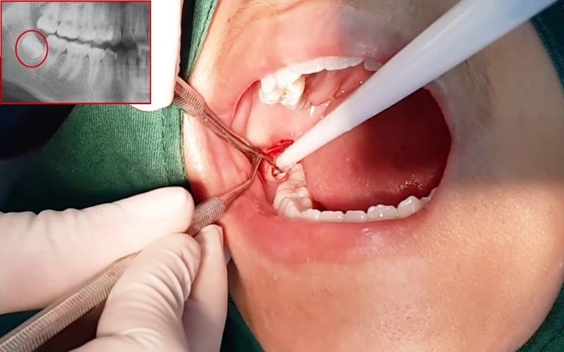 Nhổ răng khôn xử lý viêm lợi trùm