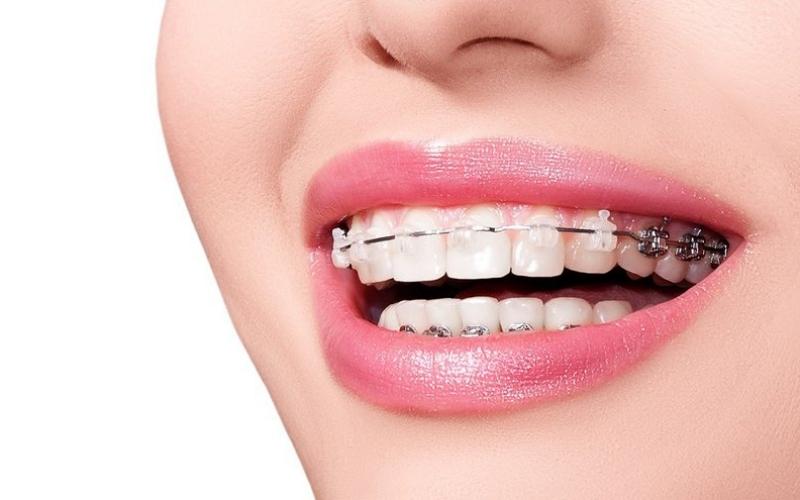 Niềng răng giúp cải thiện khớp cắn ngược hiệu quả