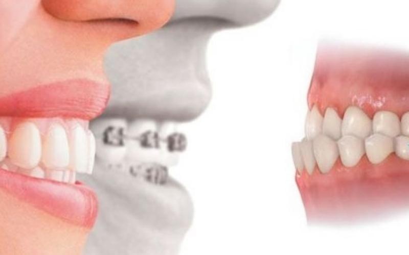 Niềng răng là giải pháp cải thiện tình trạng răng móm hiệu quả