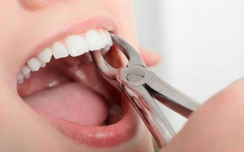 Tùy vào tình trạng răng của người bệnh mà bác sĩ chỉ định có nhổ răng hay không