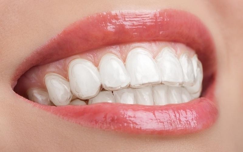 Đeo máng tẩy trắng răng tại nhà là phương pháp được áp dụng phổ biến hiện nay