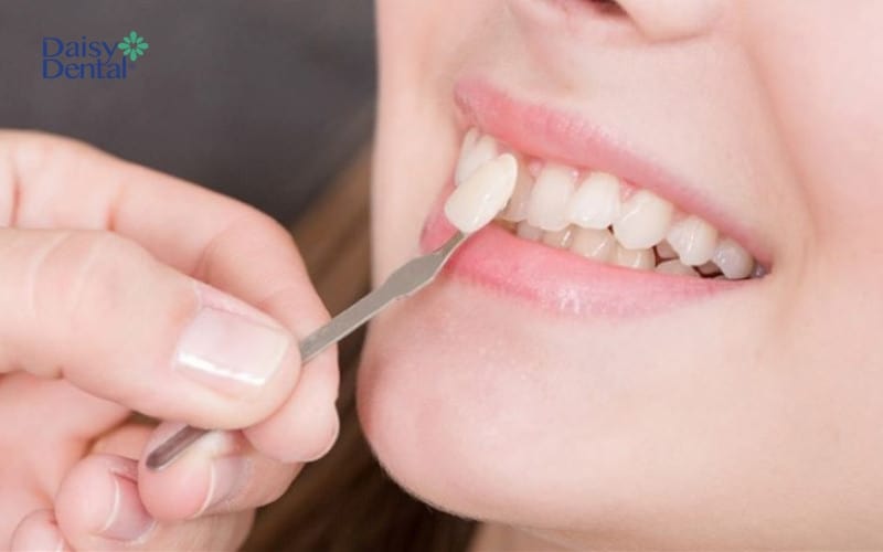 Răng lệch lạc nhẹ có thể thực hiện dán sứ để cải thiện