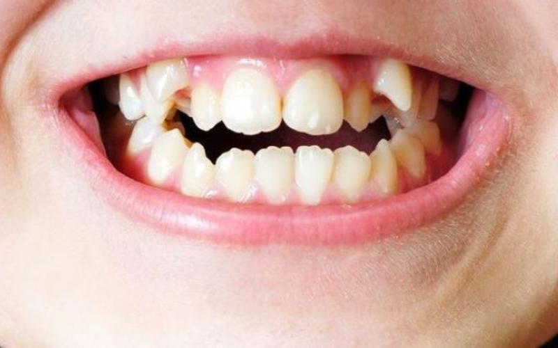 Nhiều trẻ mới sinh ra đã có dấu hiệu răng mọc chồi