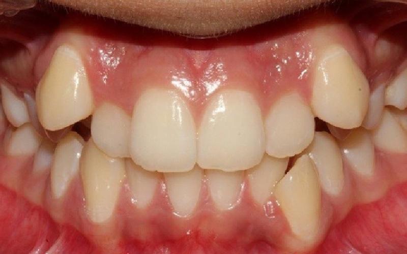 Răng mọc chồi là một dạng sai lệch khớp cắn