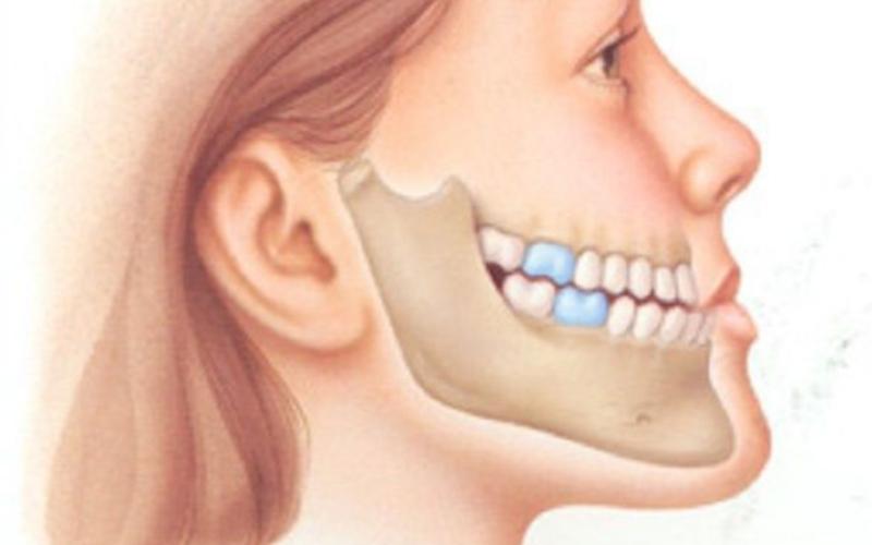 Răng móm là tình trạng khớp cắn mọc chĩa về phía trước