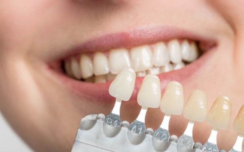Tại sao răng sứ bị lệch màu so với răng thật?