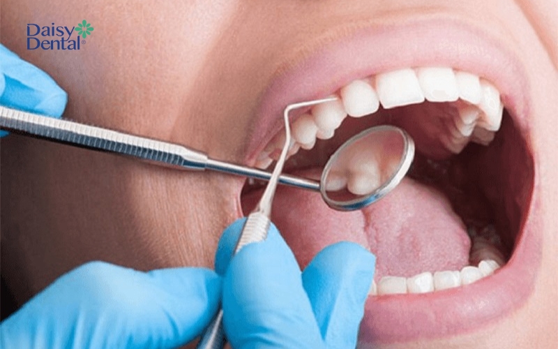 Thăm khám răng miệng định kỳ 6 tháng/lần giúp ngăn ngừa viêm lợi hiệu quả