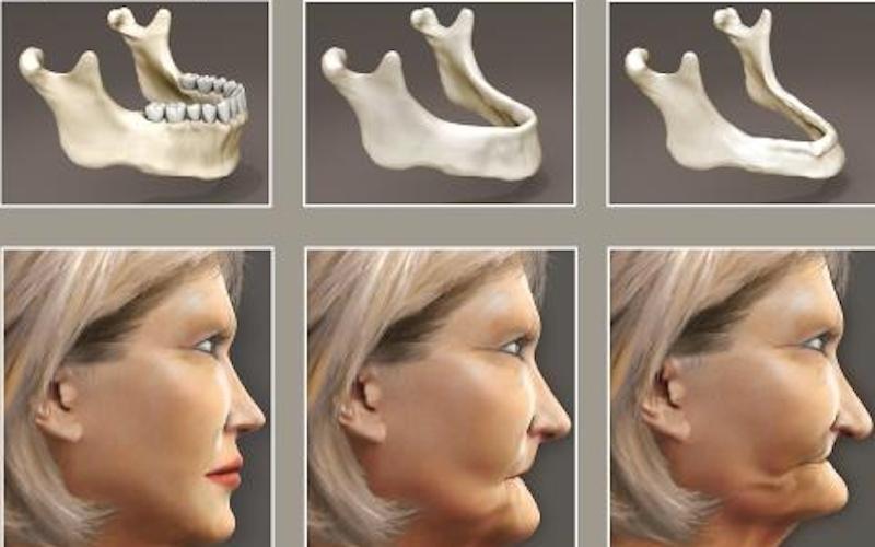Tiêu xương dẫn đến tình trạng răng lệch lạc, sai khớp cắn