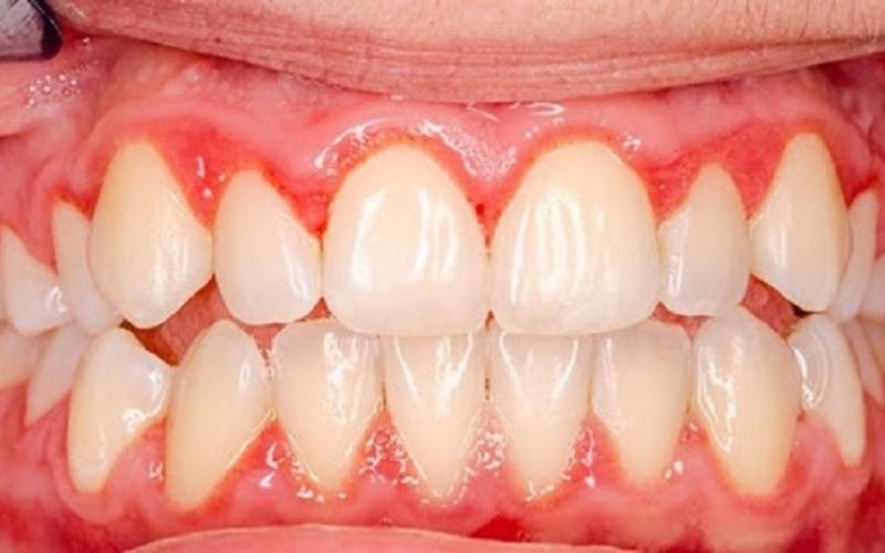 Tiêu xương răng dẫn đến tình trạng tụt nướu xương ổ răng