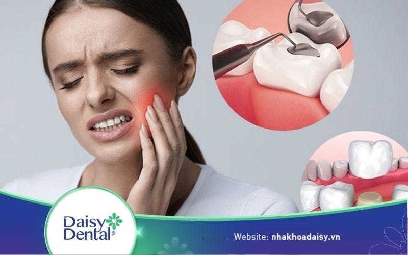 Bọc răng sứ có bị sâu răng không? Cách điều trị sâu răng sau bọc sứ