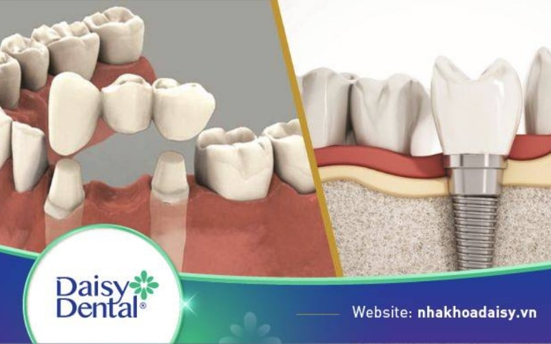 cầu răng sứ và Implant